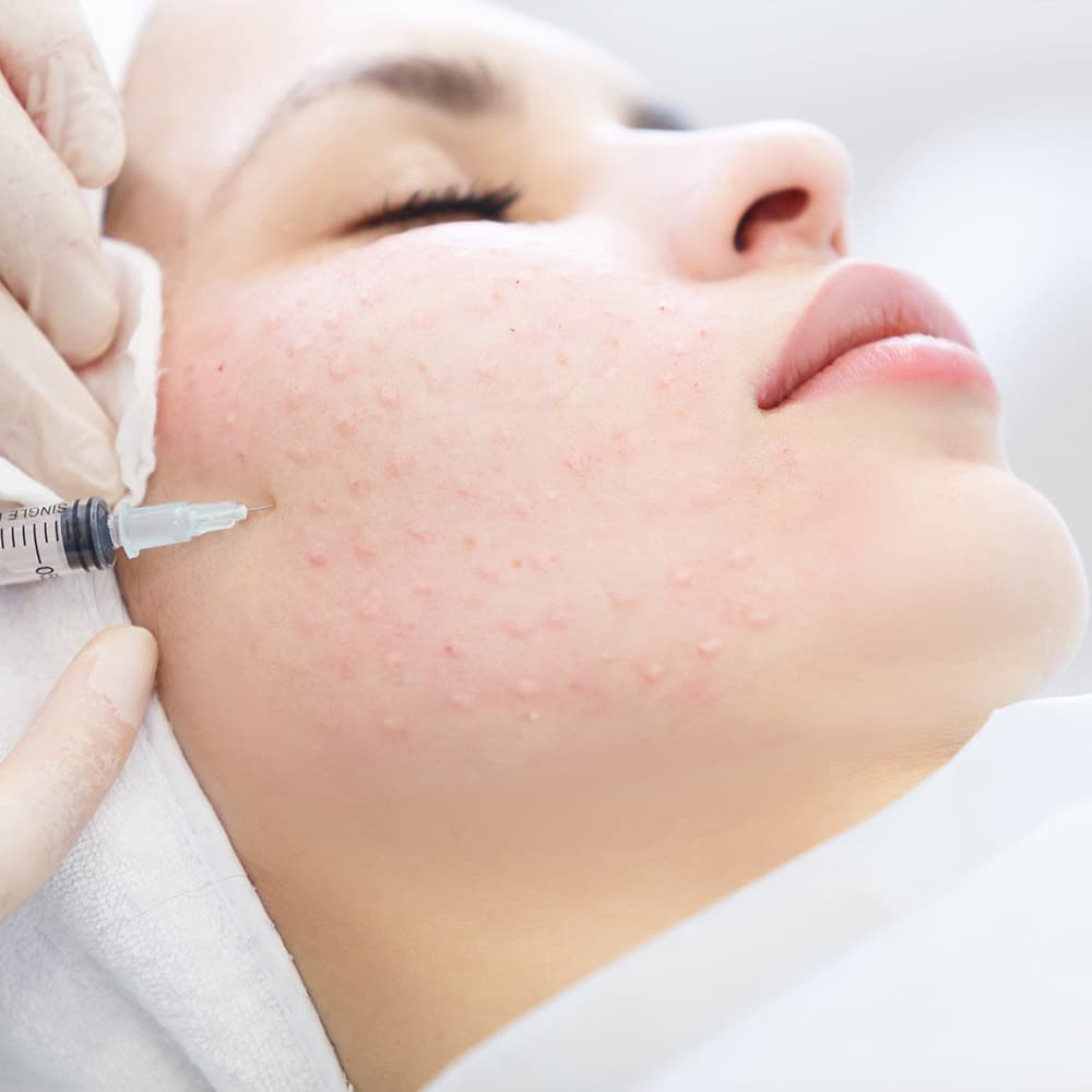 Mesoterapia Facial — Rostro completo